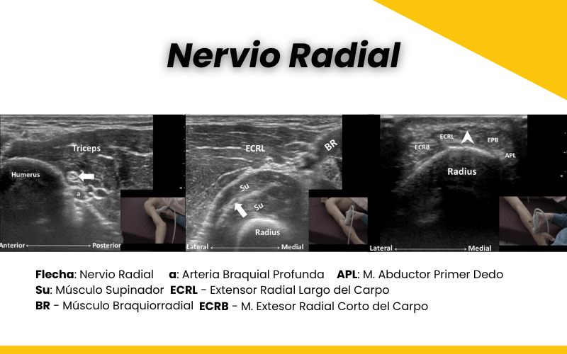 Nervio radial ecografia tempo formacion.png